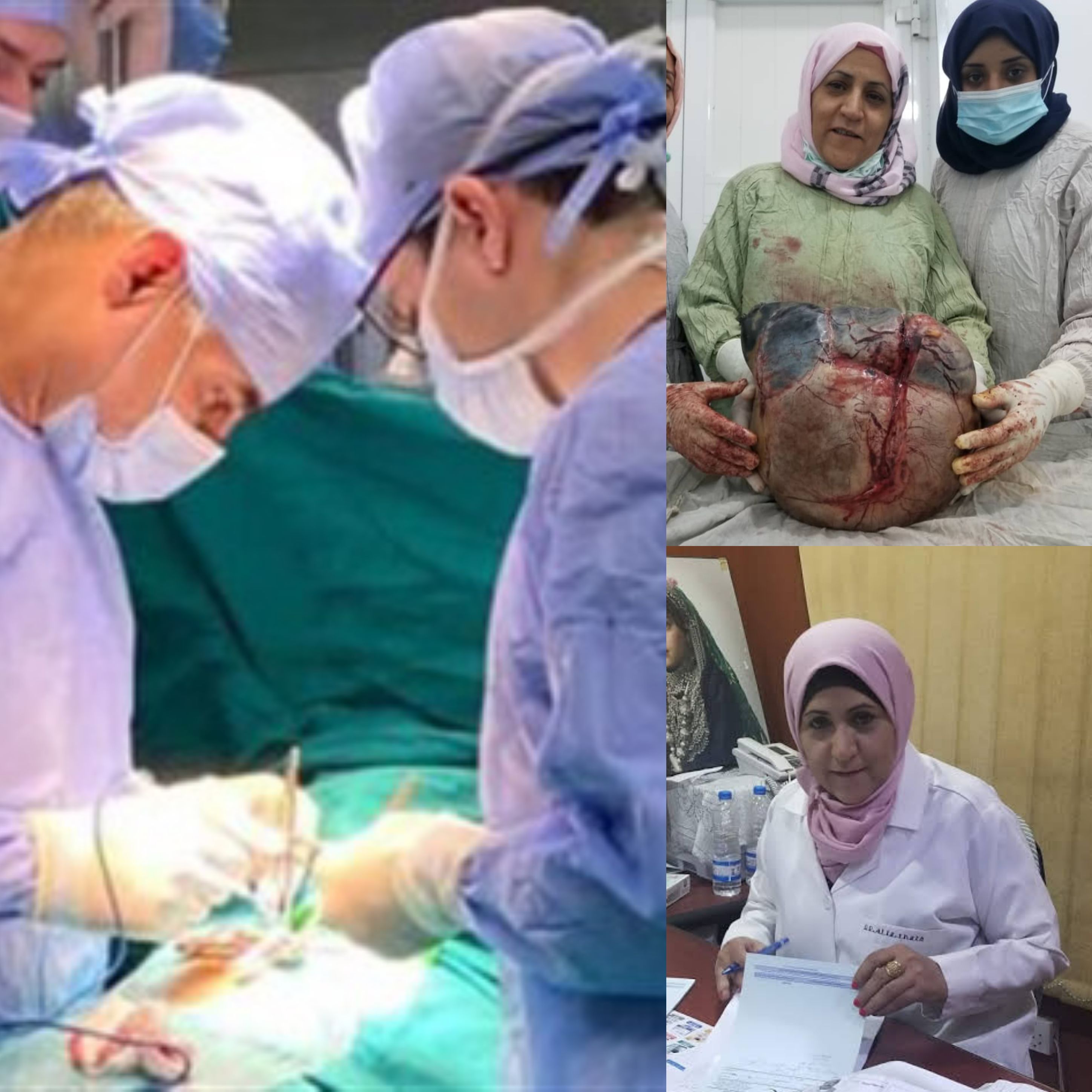 شاهد فريق طبي يمني ينجح في إستئصال ورم وزنه 10 كليو جرامات من مبيض إمرأة في العقد السابع صور