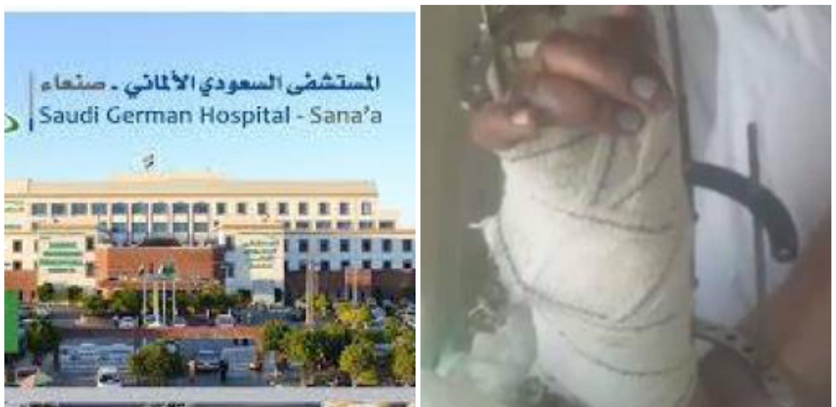 لأول مرة في اليمن .. فريق طبي ينجح في زراعة يد مبتورة بالمستشفى السعودي الألماني بصنعاء (صورة)..
