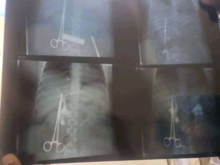 ليست المرة الأولى في حادثة خطيرة وفي ظل مايسمى تقييم وزارة الصحة مقص جديد في بطن يمنية يثير غضب واسع صورة